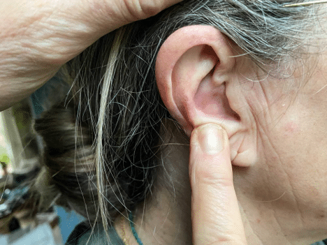 An Indiana resident showing painful pimples in their ear.